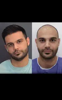 کاشت مو ابرو/فیلربادی/عمل بینی غبغب/بلفارو