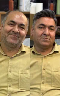 پروتز موی مردانه زنانه
