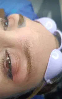 پاک کردن تاتو با دستگاه کیوسویچ پیکشور پرو