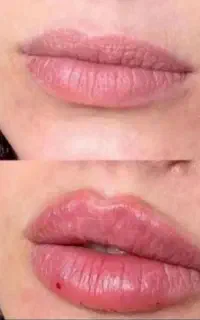 بوتاکس ۷۹۰ و ژل از ۸۹۰ تزریق فقط توسط پزشک