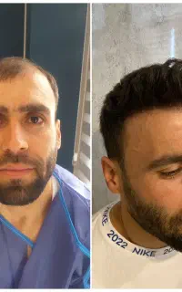 کاشت مو پی ار پی با شرایط ویژه تکنسین تبریز