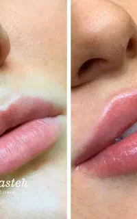جشنواره ژل لب ، بوتاکس ،نخ لیفت