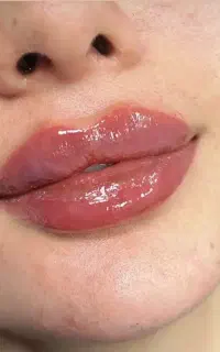 تزریق ژل و بوتاکس