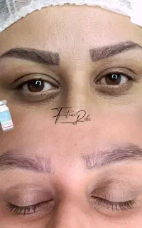 جذب مدل ریموو تتو صورت (فوری)