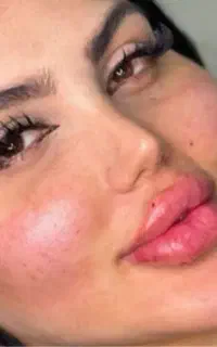 متخصص ژل و بوتاکس مزو و مزو ژل و آنزیم