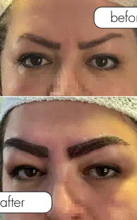کاشت ابرو دائمی در رشت-پرداخت دومرحله ای
