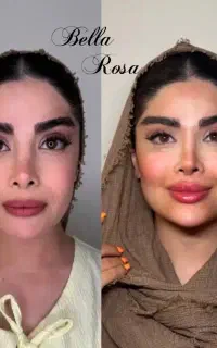 تزریق فیلر بوتاکس آنزیم مزوتراپی در مطب پزشک