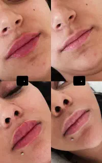 جشنواره تخفیفی بهاره فیلر بیکینی بوتاکس لیزر