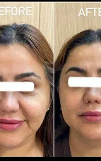 لیفت صورت، رفع غبغب، هایفو تراپی