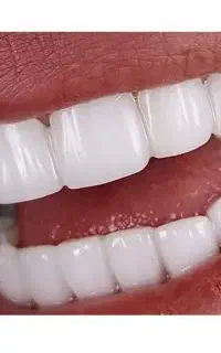 تخفیف کامپوزیت دندان