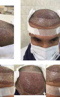 کاشت مو در بندرعباس، هماهنگی در قشم