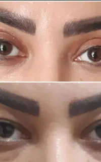 بلفاروپلاستی ،لیفت صورت و شقیقه،ساکشن غبغب