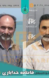 کاشت مو اقساطی و تضمینی بدون پیش پرداخت در اهواز