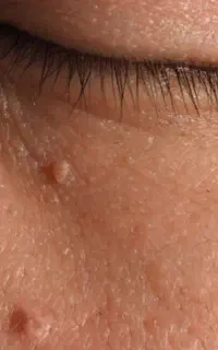 برداشتن منگوله و خال های پوستی