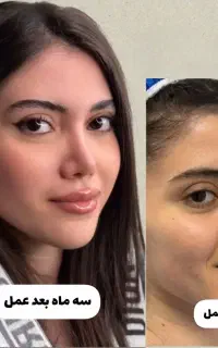 جراحی بینی،شروع زیبایی با ۵۰درصد تخفیف در تهران