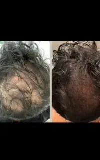 دستگاه رویش مو و ریش