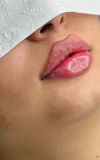 ژل و بوتاکس  900