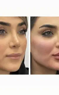 تزریق ژل فیلر بوتاکس توسط پزشک مجرب/ولیعصر