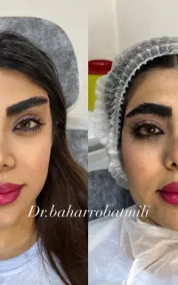مدل ژل فیلر بوتاکس انزیم مزو