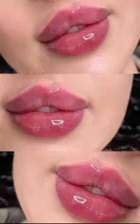 تخفیفات ویژه فیلر و بوتاکس (فقط ۸۹۹)ب مدت محدود
