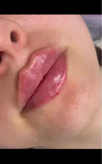 تزریق فیلر لب وچانه و زاویه فک وبوتاکس،1/200
