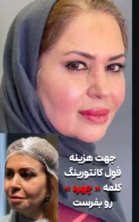 لیفت کامل صورت به روش فولیو بدون جراحی توسط پزشک