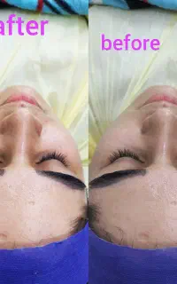 پاکسازی صورت و کاشت موقت(هیدن) و لیفت ابرو