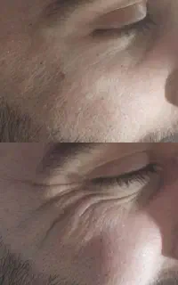 آف ژل وبوتاکس به مدت محدود