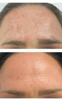 تزریق بوتاکس و ژل و مزوتراپی وprpدر کلینیک زیبایی
