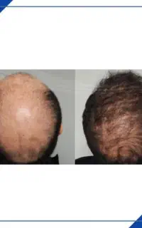 تضمیمی موهات جنگل کن