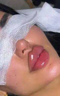 تزریق فیلر،ژل بوتاکس آقایان و بانوان