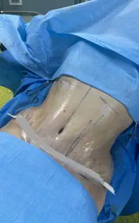 پیکرتراشی لیپوماتیک 40 م آبدو مامو پروتز لیفت لیپو