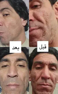 پاکسازی وفیشال تخصصی پوست