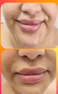 فیلر و بوتاکس .ساعت تماس ۱۶ الی ۲۰