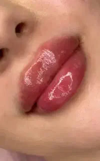 کلینیک ژل بوتاکس لیزر فیلر لب ریموو تتو خال کربن