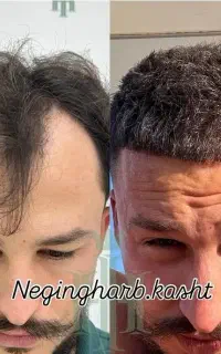 کاشت مو دائمی باضمانت کتبی ۲۴.۹۰۰