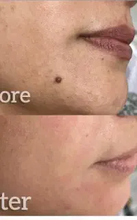 خالبرداری با دستگاه پیشرفته توسط پزشک