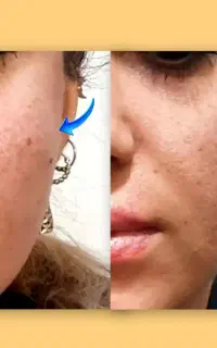 تزریق بوتاکس و فیلر طبیعی(مشاوره رایگان)