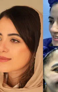 عمل جراحی بینی با تکنیک نوین و ترکیبی seg+tig