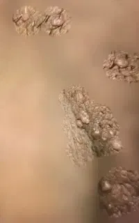 از بین بردن ریشه ای HPV.زگیل و ناباوری