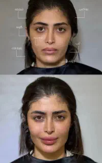 ساکشن غبغب ،بلفارو پلک ،فیلرو لیفت صورت و شقیقه