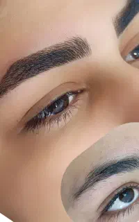 میکروظریف و ریموتخصصی توسط پیراپزشک