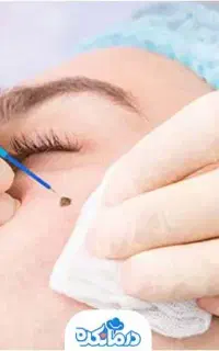 برداشت خال و گوشت اضافی صورت و بدن