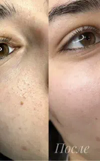 فیشیال تخصصی و درمانی (پاکسازی)