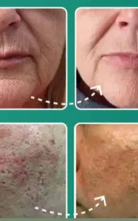 آراف فرکشنال منافذبازوجای اسکارهای قدیمی وجوش صورت