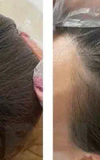 مرکز تخصصی پی ار پی ضد ریزش مو و جوانسازی پوست