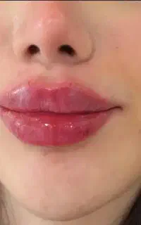 OFF(تخفیف) ژل  و مزو