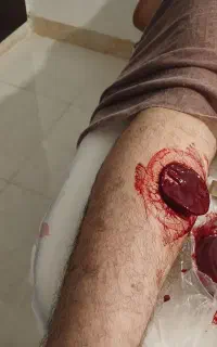 حجامت بادکش زالو شکستگی ودررفتگی کل بدن سیاتیک