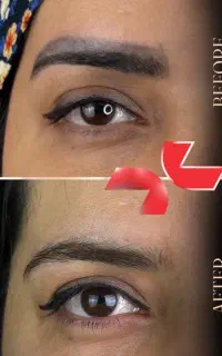 پاک کردن تخصصی تتو ابرو و تتوی بدن بدون نقاهت