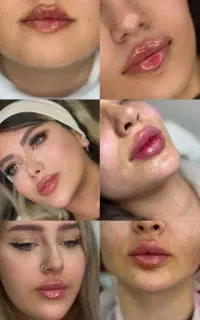 خدمات تخصصی ژل و بوتاکس